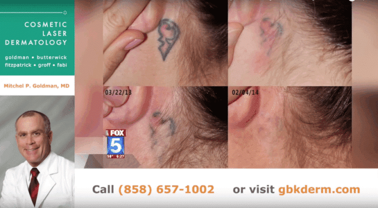 Before and after side image of laser tattoo removal on a female's neck performed by Dr. Goldman at our San Diego medical clinic