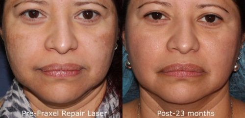 melasma laser skin treatment san diego