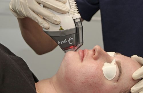 cosmetic laser dermatology laser treatments san diego ca