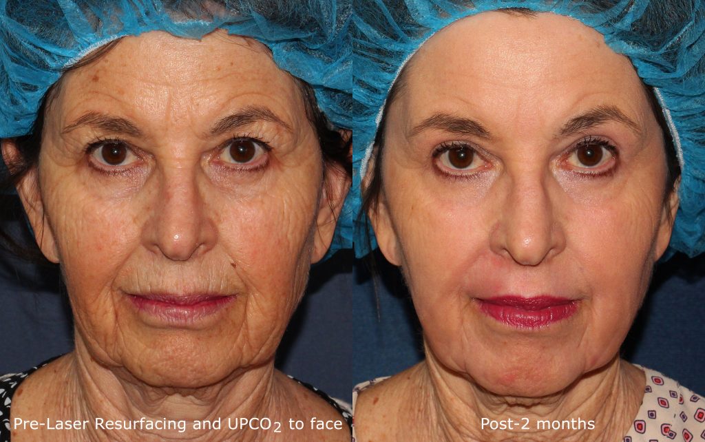 Deep Wrinkle Treatment Med Spa San Diego CA CLDerm