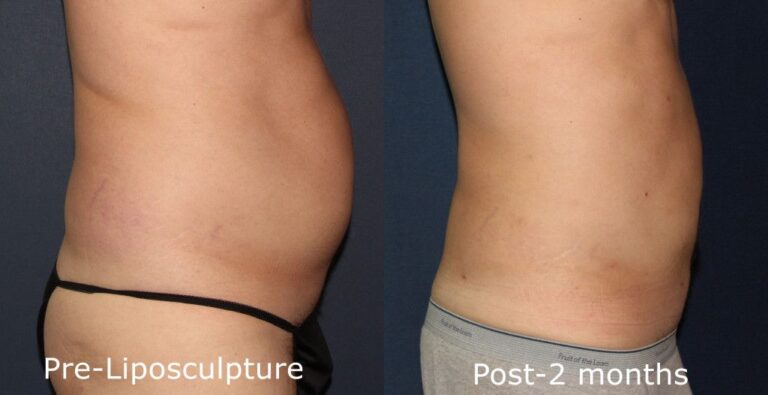 Before and after side image of a liposculpture treatment on a female's abdomen performed by Dr. Groff at our San Diego medical clinic