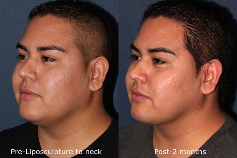Before and after oblique image of liposculpture treatment on a male's neck and chin performed by Dr. Groff at our San Diego medical spa