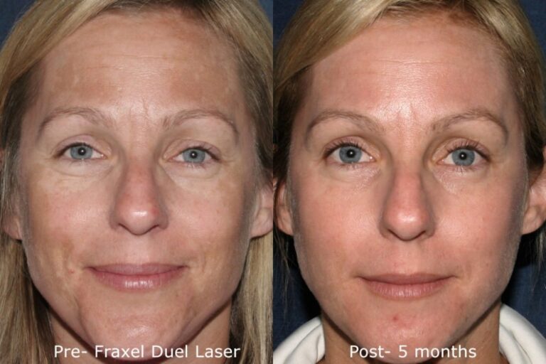 Before and after front image of Fraxel Dual treatment on a female's face to treat melasma performed by Dr. Groff at our San Diego medi spa