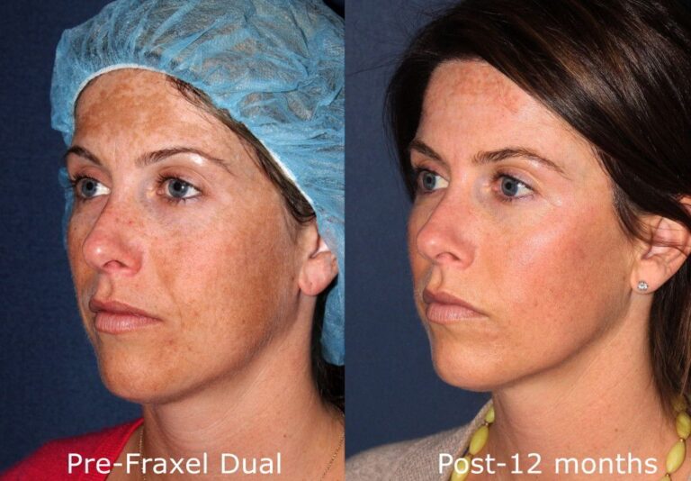 Before and after oblique image of Fraxel Dual treatment on a female's face to treat melasma performed by Dr. Fabi at our San Diego medi spa