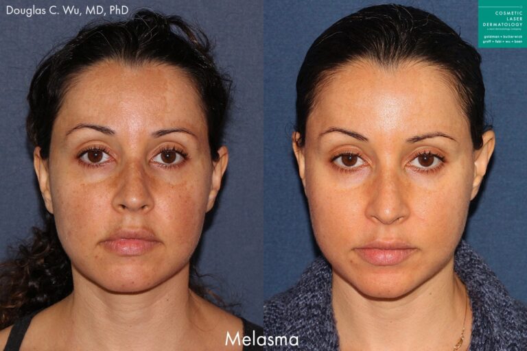 Laser treatment to reduce symptoms of melasma by Dr. Wu. After the procedure, patient's skin is clearer and brown discoloration is visibly reduced.