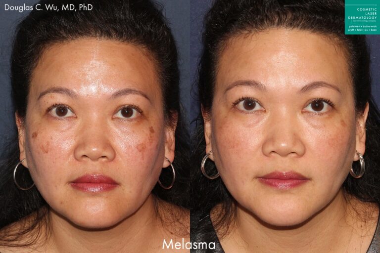 Laser resurfacing to treat melasma by Dr. Wu. After procedure, patient's skin is clearer and brown spots are significantly reduced.