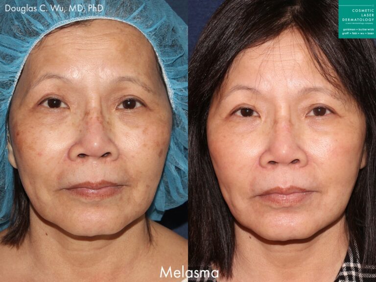 Laser resurfacing to treat melasma by Dr. Wu. Treatment removes brown spots and discoloration to produce clearer skin.