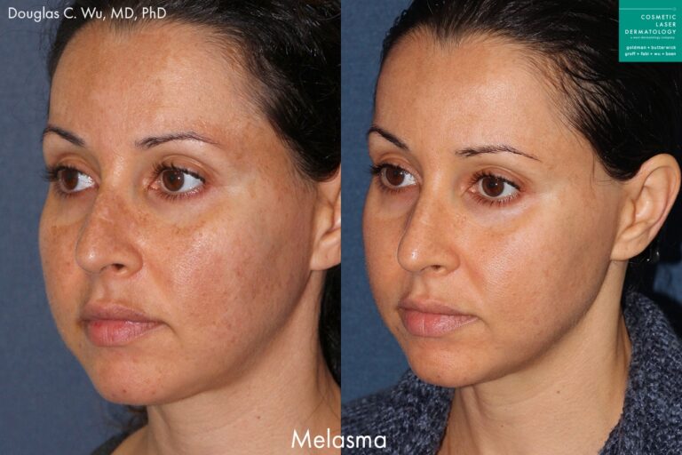 Laser treatment to reduce symptoms of melasma by Dr. Wu. After treatment, patient's skin is clearer with visibly less discoloration
