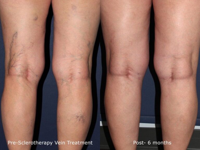 Before and after back image of sclerotherapy treatment on a female's leg veins performed by Dr. Fabi at our San Diego medical spa