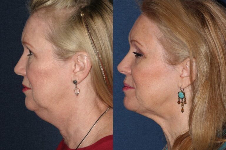 Before and after side image of Kybella treatment on a female's chin and neck performed by Dr. Fabi at our San Diego California medical spa