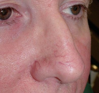 Spider Veins Nose