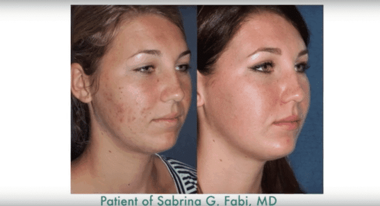 Before and after oblique image of photodynamic therapy on a female's face performed by Dr. Fabi at our San Diego medical clinic
