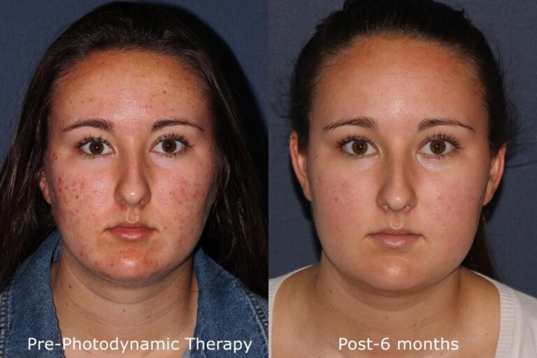 PDT for facial acne Fabi San Diego