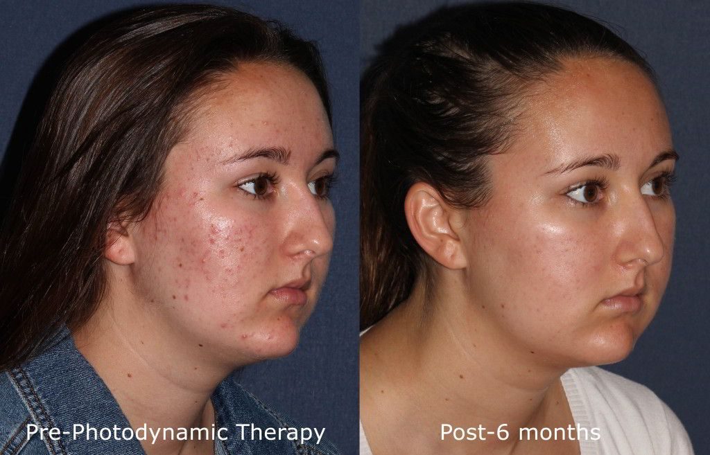 Actual un-retouched patient before and after photodynamic therapy (PDT) for acne by Dr. Fabi. Disclaimer: Results may vary from patient to patient. Results are not guaranteed.