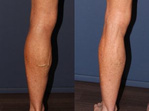 Phlebectomy Treatment Left Leg