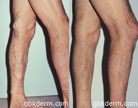 Do Compression Stockings Help Stop Varicose Veins?: Goldman Vein