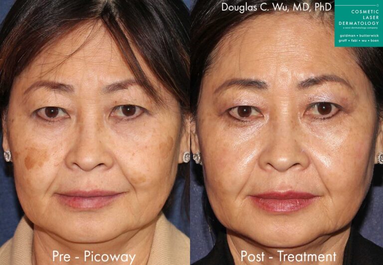 PicoWay Laser to remove brown spots and sun damage by Dr. Wu. Treatment eliminates pigmentation irregularities to produce clearer, fresher skin.