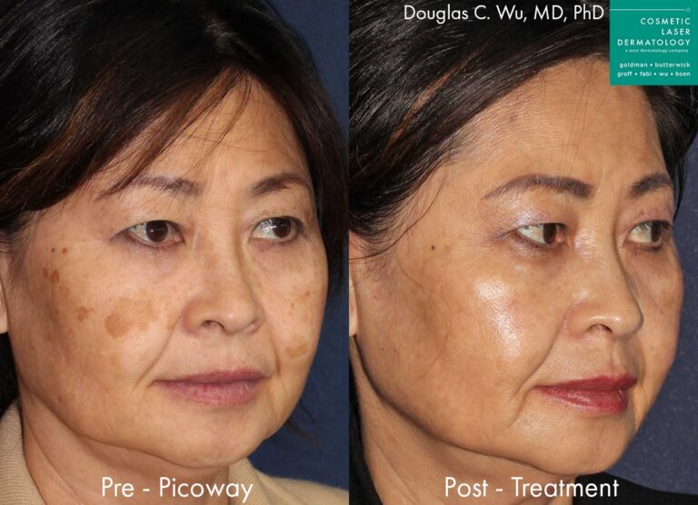 PicoWay laser to remove brown spots and treat sun damage by Dr. Wu. Treatment eliminates hyperpigmentation to create clearer, fresher skin.