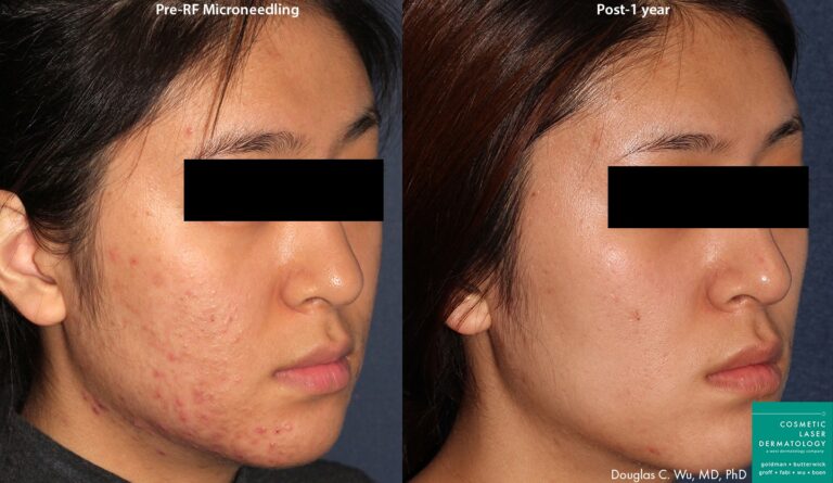 RF microneedling to treat acne and acne scarring by Dr. Wu. After treatment, skin is clearer and smoother.