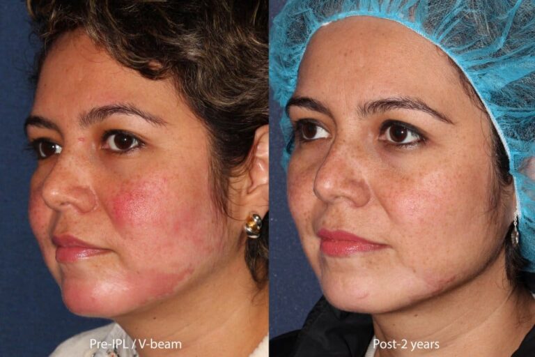 Before and after oblique image of IPL and Vbeam treatment on a female's face performed by Dr. Fabi at our San Diego medi spa