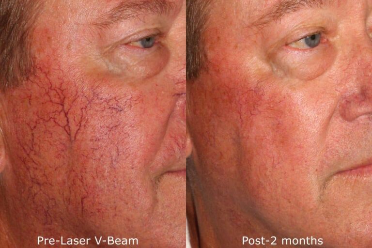Before and after oblique image of Vbeam treatment on a male's facial veins performed by Dr. Groff at our San Diego medi spa