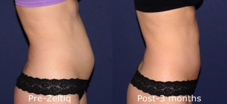 Before and after side image of CoolSculpting treatment on a female's abdomen performed by Dr. Wu at our San Diego medi spa