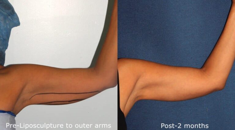 Before and after front image of liposculpture treatment on a female's arms performed by Dr. Fabi at our San Diego medi spa
