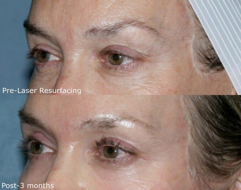 Before and after oblique image of Affirm laser treatment on a female's facial wrinkles performed by Dr. Groff at our San Diego medical clinic