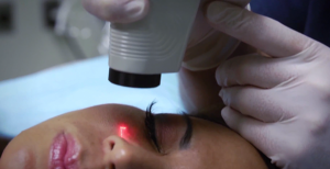 spider vein treatment san diego