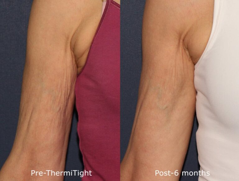Before and after front image of ThermiTight treatment on a female's arms performed by Dr. Fabi at our San Diego medi spa