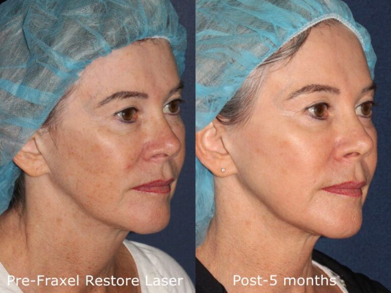 Before and after oblique image of Fraxel Restore laser treatment on a female's face performed by Dr. Fabi at our San Diego med spa