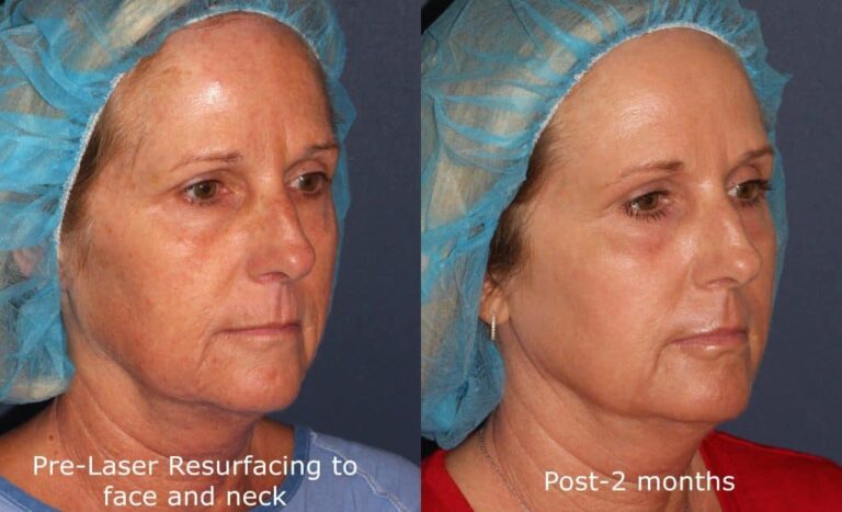 Before and after oblique image of Fraxel Restore laser treatment on a female's face performed by Dr. Groff at our San Diego med spa