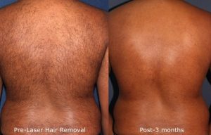 Unwanted Hair Treatment La Jolla