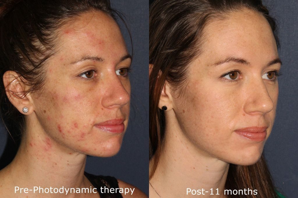 Actual un-retouched patient before and after photodynamic therapy (PDT) for acne scars by Dr. Groff. Disclaimer: Results may vary from patient to patient. Results are not guaranteed.