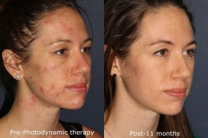 Before and after oblique image of photodynamic therapy on a female's face performed by Dr. Groff at our San Diego medical spa