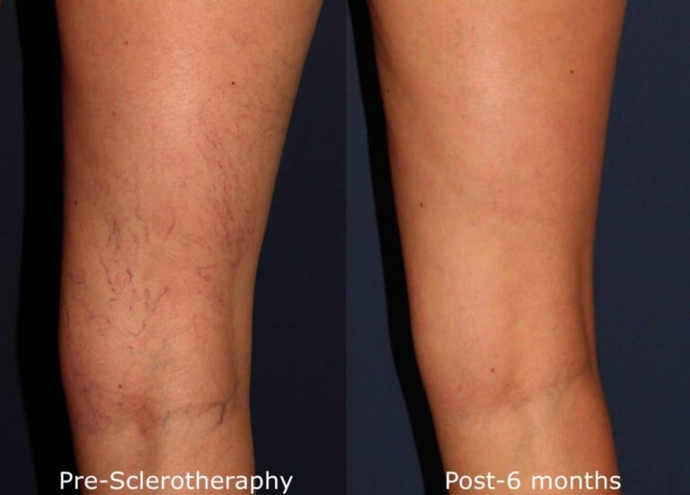 Before and after back image of sclerotherapy treatment on a female's leg veins performed by Dr. Wu at our San Diego medical spa