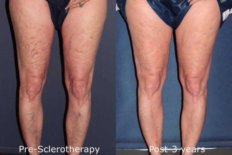 Before and after front image of sclerotherapy treatment on a female's leg veins performed by Dr. Goldman at our San Diego medical spa