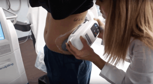 coolsculpting on stomach san diego
