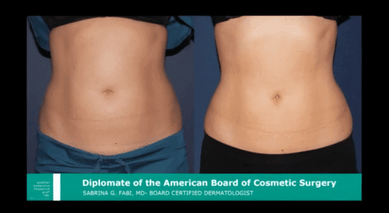 Before and after front image of CoolSculpting treatment on a female's abdomen performed by Dr. Fabi at our San Diego medical spa