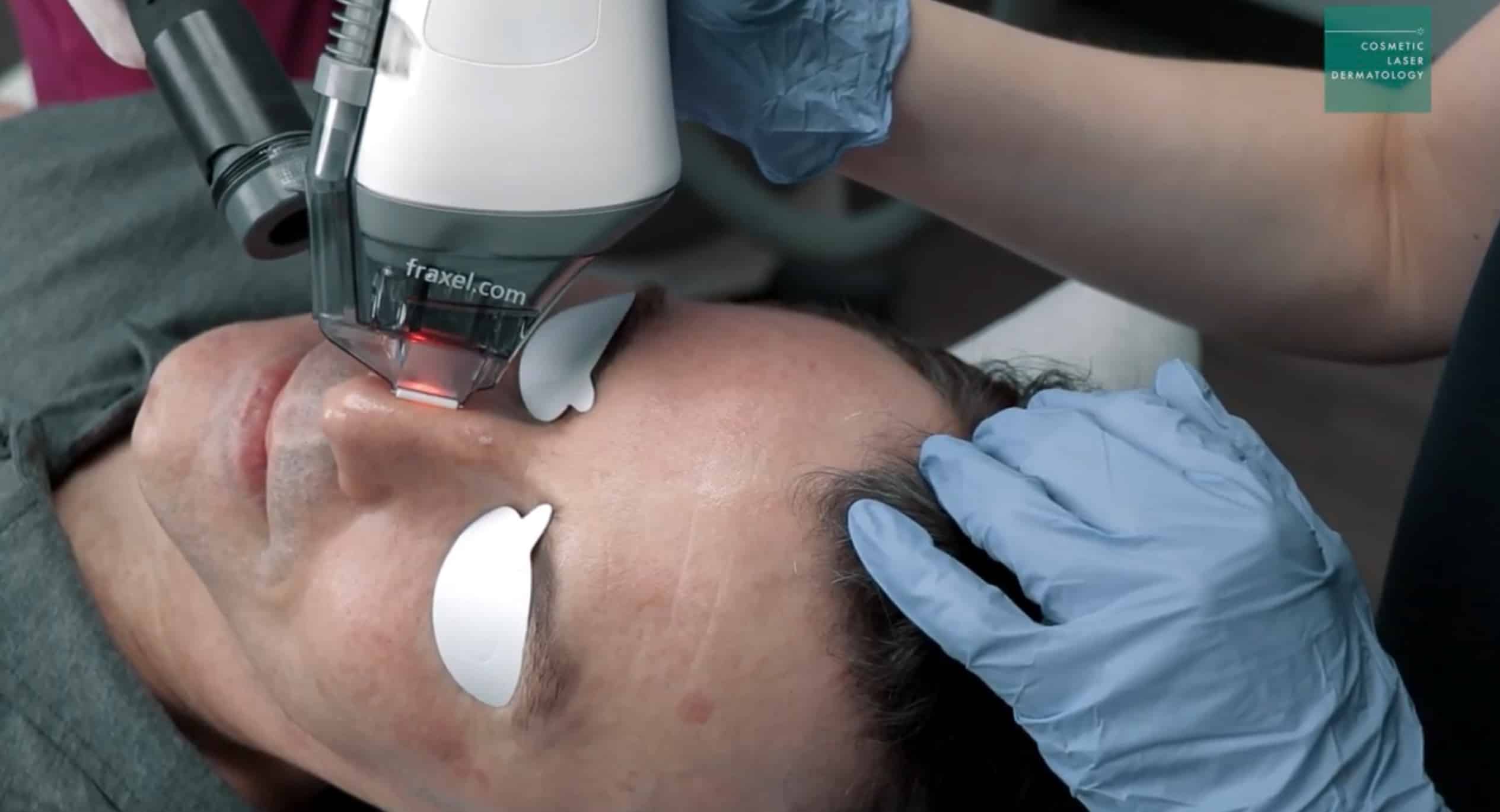 before and after fraxel laser treatment in san diego