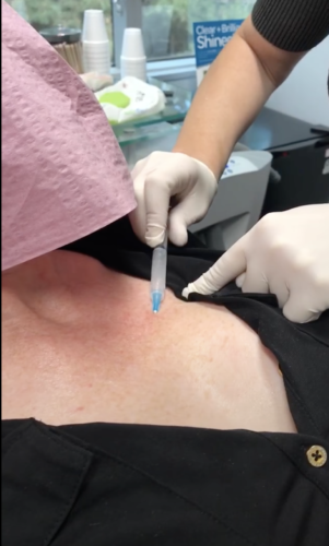 Board Certified Dermatologist Dr. Sabrina Fabi demonstrates a Sculptra procedure on the chest of a young woman in San Diego, CA.