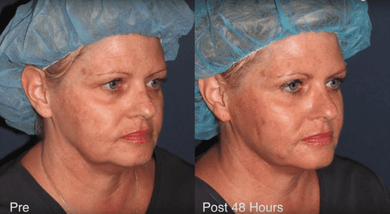 Before and after oblique image of the Silhouette InstaLift on a female's face at our San Diego medical clinic