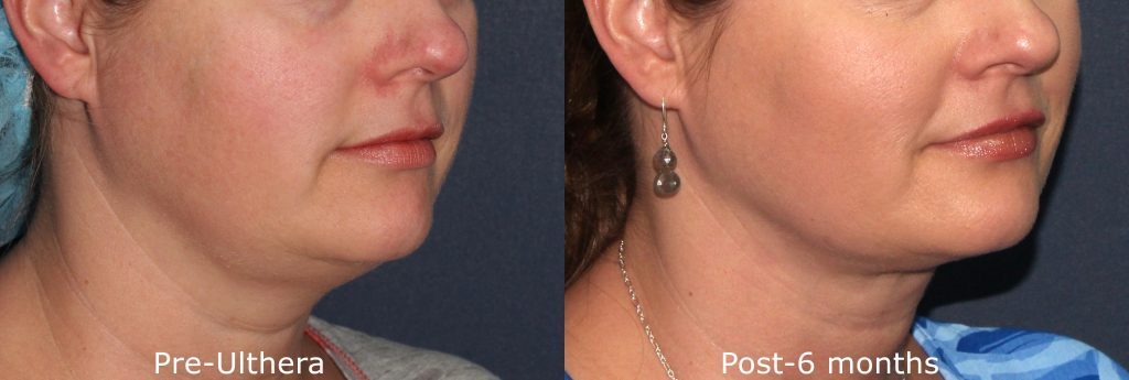 Actual unretouched patient before and after Ultherapy to tighten skin under the chin by Dr. Fabi. Disclaimer: Results may vary from patient to patient. Results are not guaranteed.