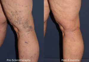 Before and after side image of sclerotherapy treatment on a female's leg veins performed by Dr. Wu at our San Diego medical spa