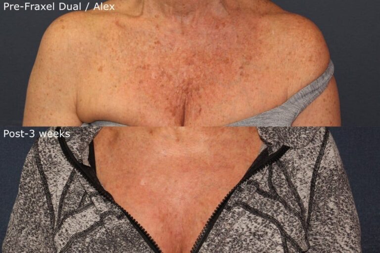 Before and after front image of Fraxel Dual and Alexandrite laser treatment on a female's chest performed by Dr. Groff at our San Diego medical spa