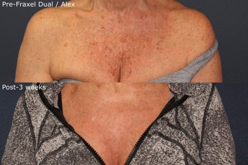 Sun Damage & Brown Spot Removal, San Diego, CA