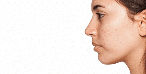 Acne Treatment La Jolla