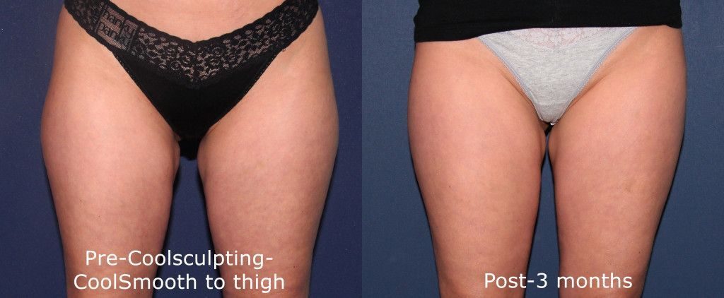 Thigh Body Contouring CoolSculpting results