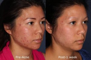 San diego Aesthetic Facial Acne Peel Sensitive Skin