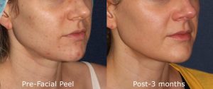 Acne Reduction Peel San Diego